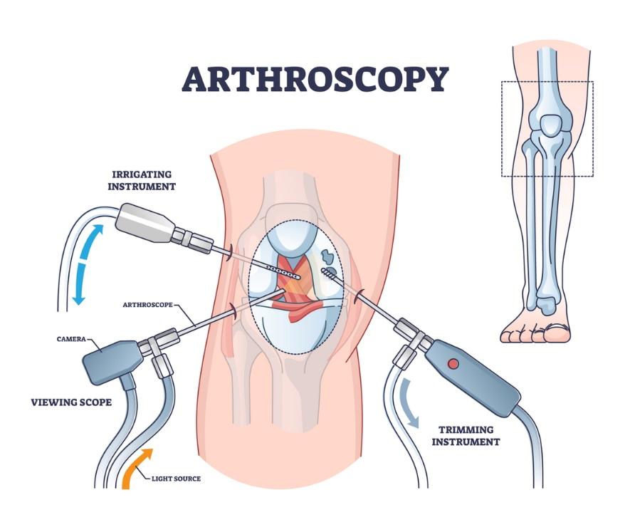 Conditions Treated with Arthroscopy | Orthopedics Associates